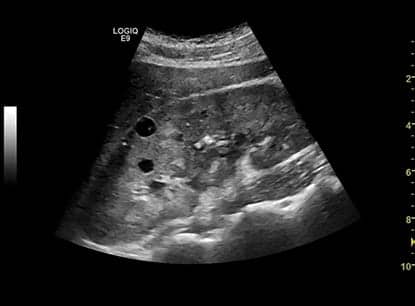 Focus Logiq-E9-Chronic-Renal