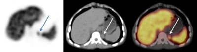 Images from a dual SPECT/CT camera 