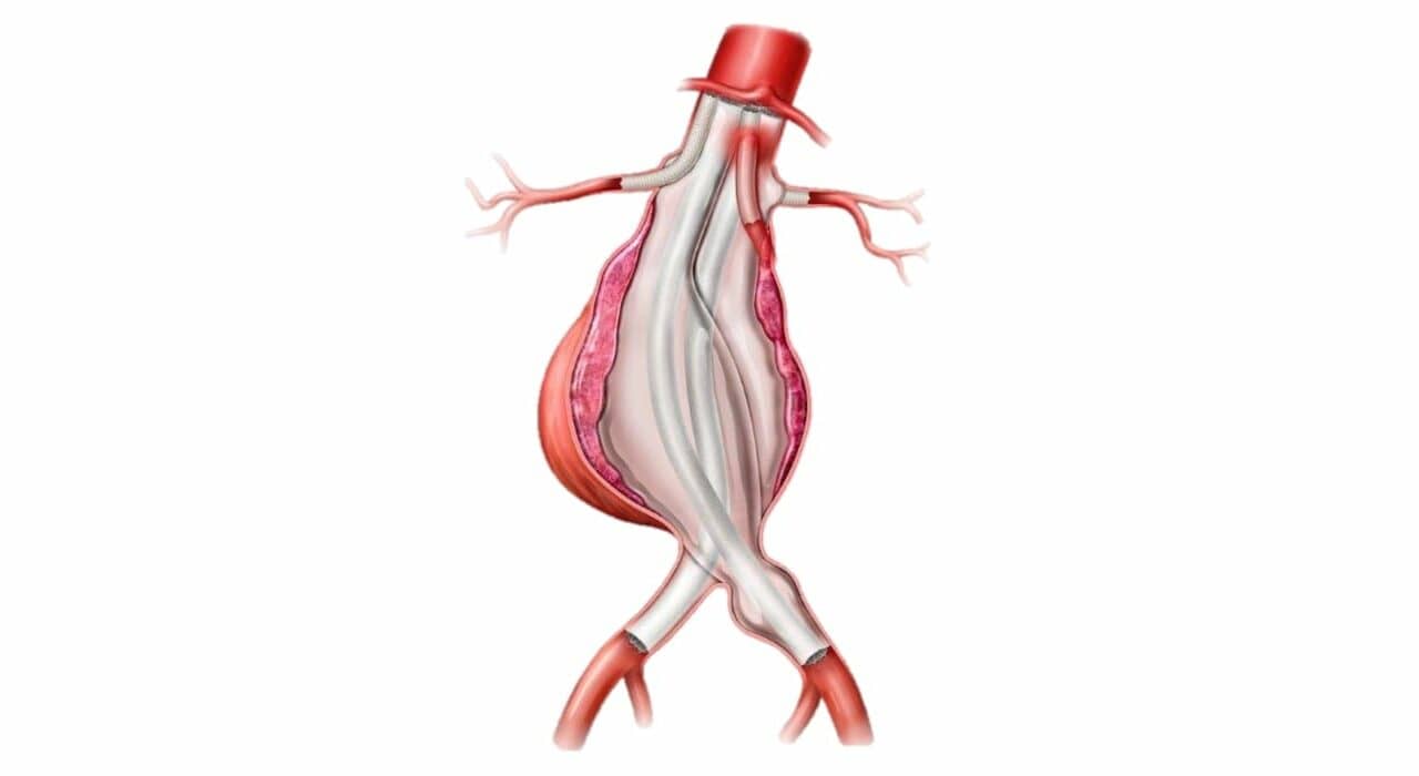 Endologix ChEVAS System Gets FDA Breakthrough Device Designation