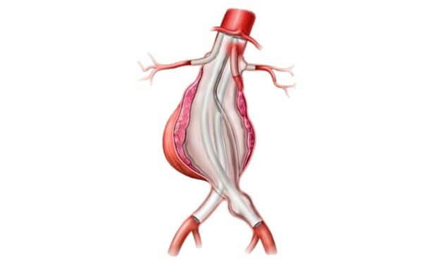Endologix ChEVAS System Gets FDA Breakthrough Device Designation