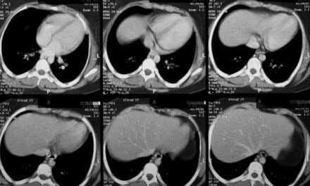 How to Cut CT Contrast Dye Use Amid Global Shortage