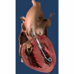 FDA Approves Abiomed’s Impella ECP Heart Pump