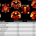 Siemens Healthineers Debuts Biograph Vision.X PET/CT Scanner