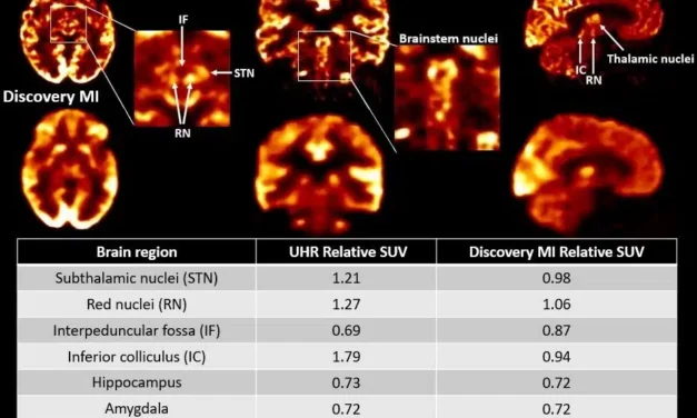 Siemens Healthineers Debuts Biograph Vision.X PET/CT Scanner