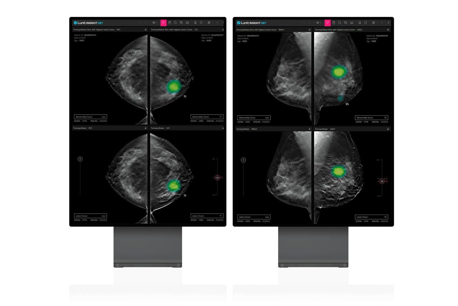 SimonMed Imaging Partners with Lunit for AI for Breast Cancer Detection