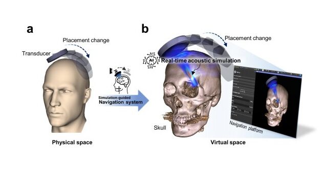 Researchers Use AI to Improve Brain Ultrasound Therapy