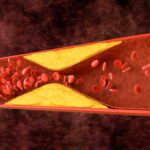 AI-Driven Coronary Physiology Software Gains FDA Clearance