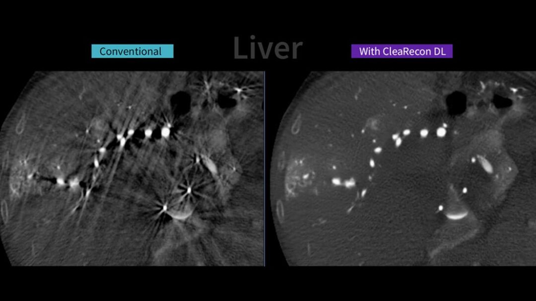 New AI-Based Tool Aims to Enhance CBCT Image Quality in Interventional Suites
