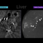New AI-Based Tool Aims to Enhance CBCT Image Quality in Interventional Suites
