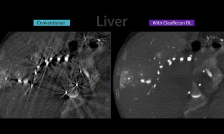 New AI-Based Tool Aims to Enhance CBCT Image Quality in Interventional Suites
