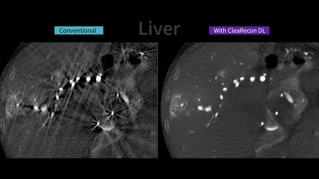 New AI-Based Tool Aims to Enhance CBCT Image Quality in Interventional Suites