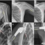 X-Ray Imaging Technique Helps Decide Best Surgery for Rotator Cuff Tears