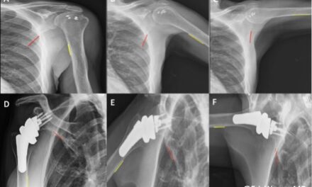 X-Ray Imaging Technique Helps Decide Best Surgery for Rotator Cuff Tears
