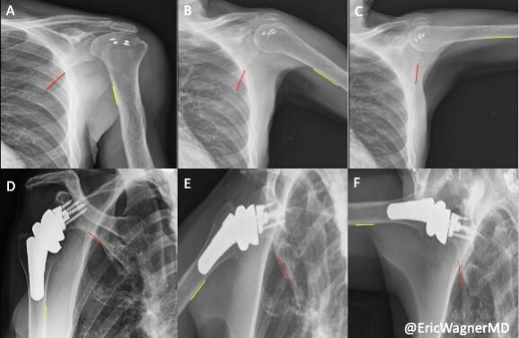 X-Ray Imaging Technique Helps Decide Best Surgery for Rotator Cuff Tears