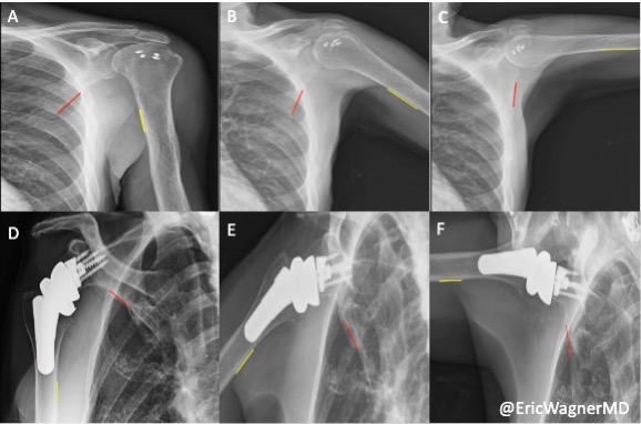 X-Ray Imaging Technique Helps Decide Best Surgery for Rotator Cuff Tears