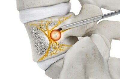 FDA Clears Basivertebral Nerve Ablation System for Low Back Pain