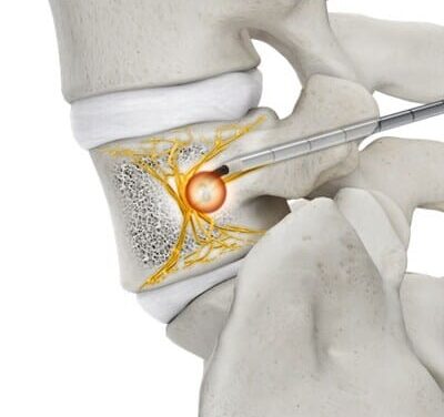 FDA Clears Basivertebral Nerve Ablation System for Low Back Pain