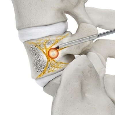 FDA Clears Basivertebral Nerve Ablation System for Low Back Pain