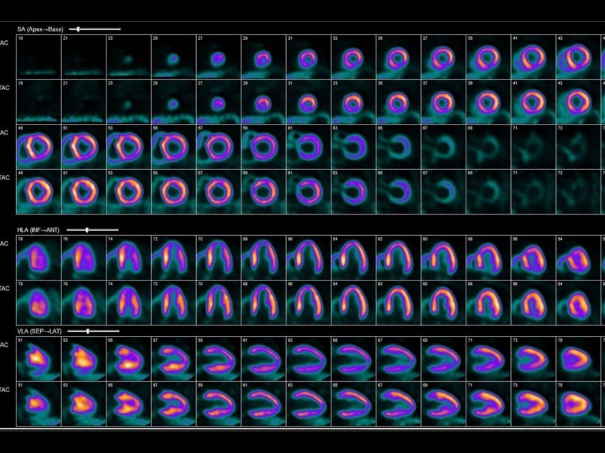 GE HealthCare Expands Access to Cardiac PET with Flurpiridaz F 18