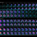 GE HealthCare Expands Access to Cardiac PET with Flurpiridaz F 18