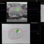 Philips Receives FDA Clearance for Image-Guided Prostate Cancer Solution