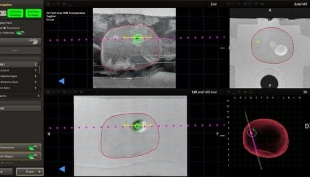 Philips Receives FDA Clearance for Image-Guided Prostate Cancer Solution