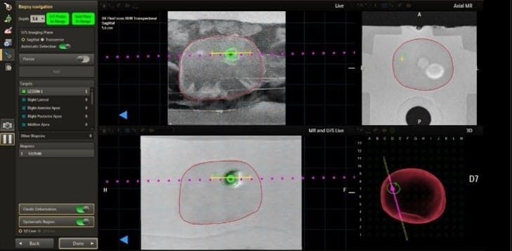 Philips Receives FDA Clearance for Image-Guided Prostate Cancer Solution