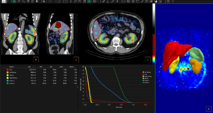 FDA Clears Updated Hermia Voxel Dosimetry Software