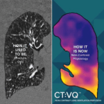 FDA Clears CT-Based Ventilation-Perfusion Software