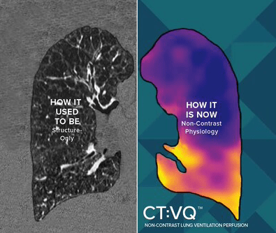 FDA Clears CT-Based Ventilation-Perfusion Software