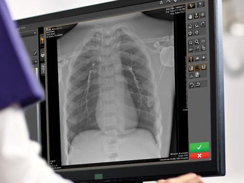 Carestream Updates Radiography Imaging Software to Support More Confident Diagnoses