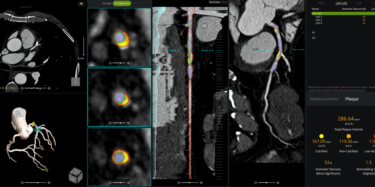 FDA Clears AI Tool for Coronary Plaque Analysis