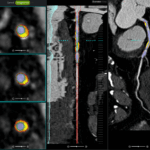 FDA Clears AI Tool for Coronary Plaque Analysis