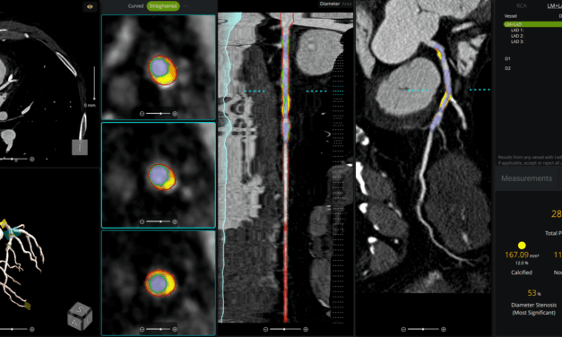 FDA Clears AI Tool for Coronary Plaque Analysis