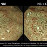 Olympus Introduces Dual-Mode Imaging Feature for Evis X1 Endoscope System