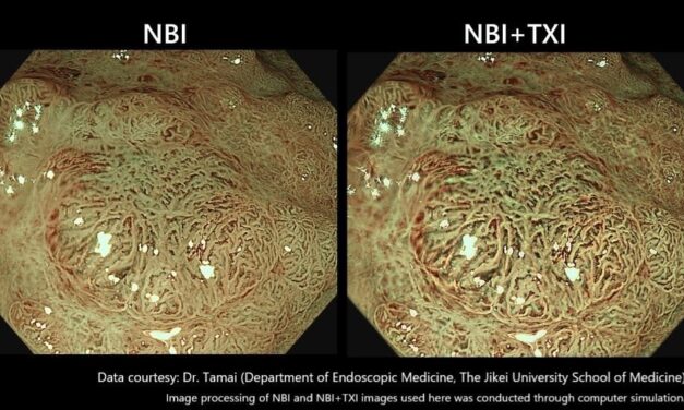 Olympus Introduces Dual-Mode Imaging Feature for Evis X1 Endoscope System