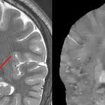 Imaging Biometrics Extends GE HealthCare Distribution Deal to Include Additional Neuroimaging Software