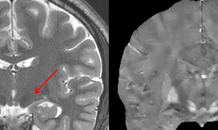Imaging Biometrics Extends GE HealthCare Distribution Deal to Include Additional Neuroimaging Software