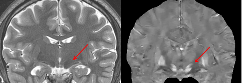 Imaging Biometrics Extends GE HealthCare Distribution Deal to Include Additional Neuroimaging Software