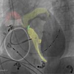 FDA Clears Platform for Noninvasive Cardiac Conduction System Visualization
