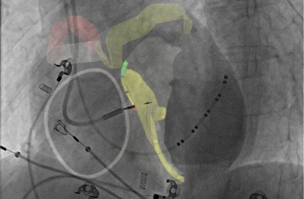 FDA Clears Platform for Noninvasive Cardiac Conduction System Visualization