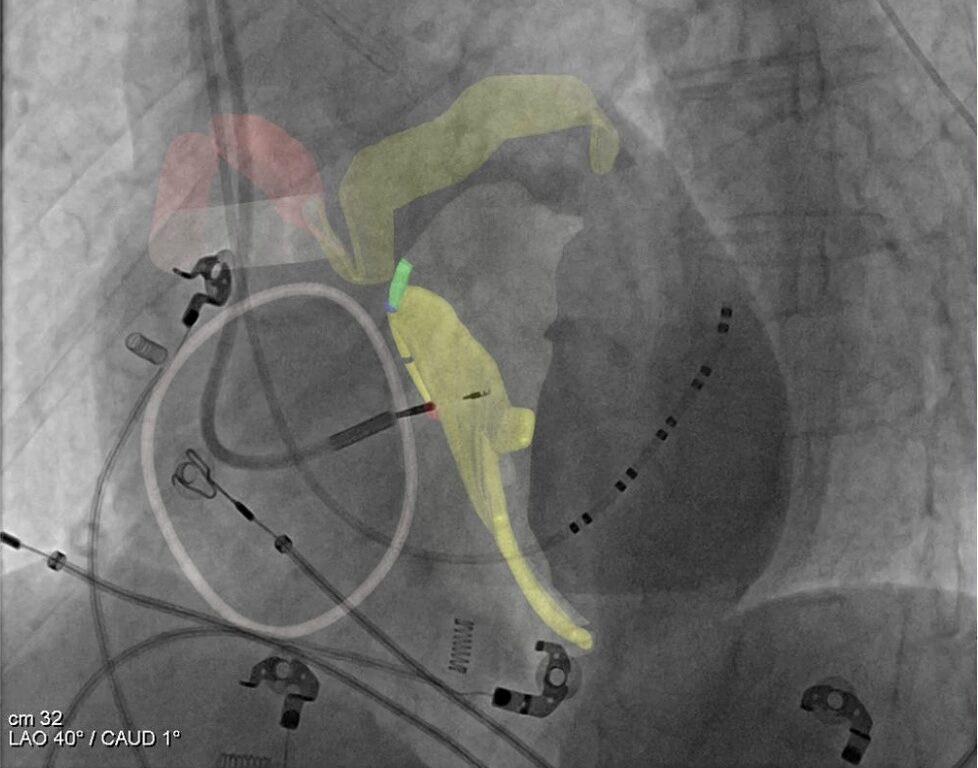 FDA Clears Platform for Noninvasive Cardiac Conduction System Visualization