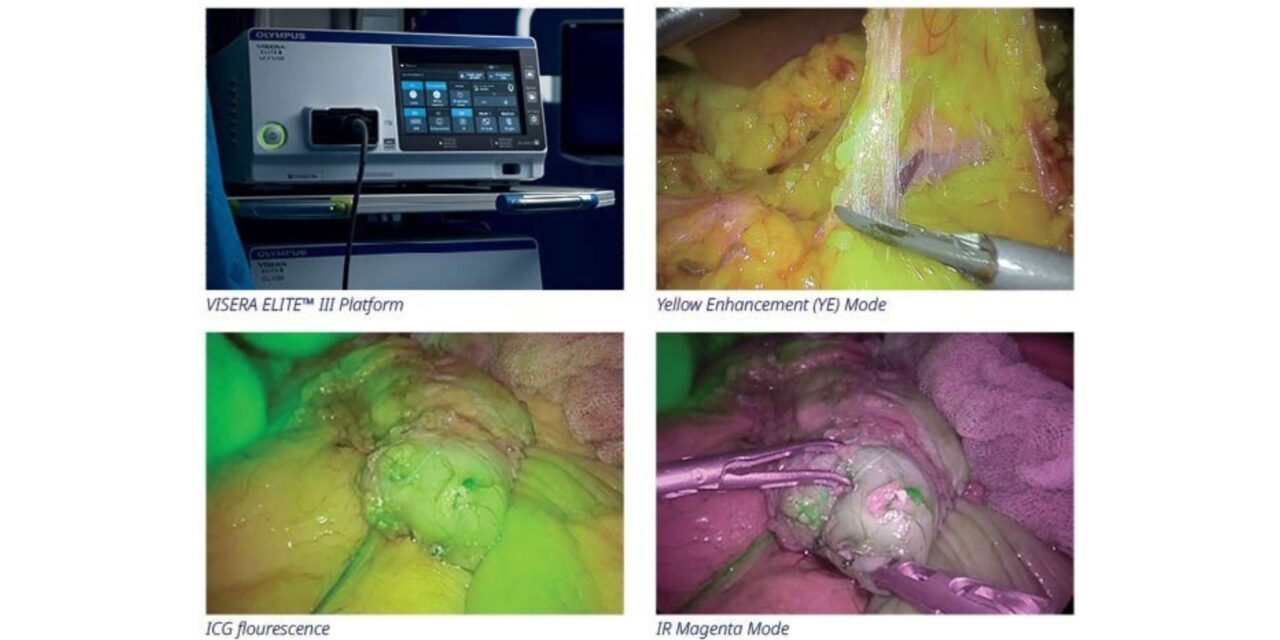 Olympus Launches Visera Elite III Surgical Imaging Platform in US