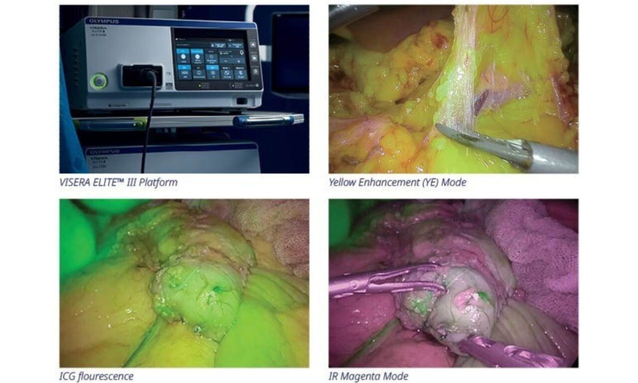 Olympus Launches Visera Elite III Surgical Imaging Platform in US