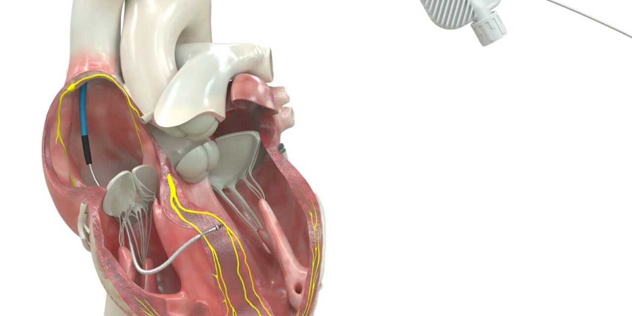 Defibrillation Lead Wins FDA Approval for Conduction System Pacing