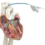 Defibrillation Lead Wins FDA Approval for Conduction System Pacing