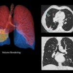 FDA Clears Deep Learning Technology for High-Resolution CT Imaging