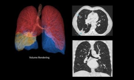 FDA Clears Deep Learning Technology for High-Resolution CT Imaging