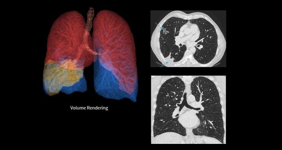 FDA Clears Deep Learning Technology for High-Resolution CT Imaging