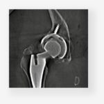 FDA Clears 3D Imaging Platform for Existing Surgical C-Arms
